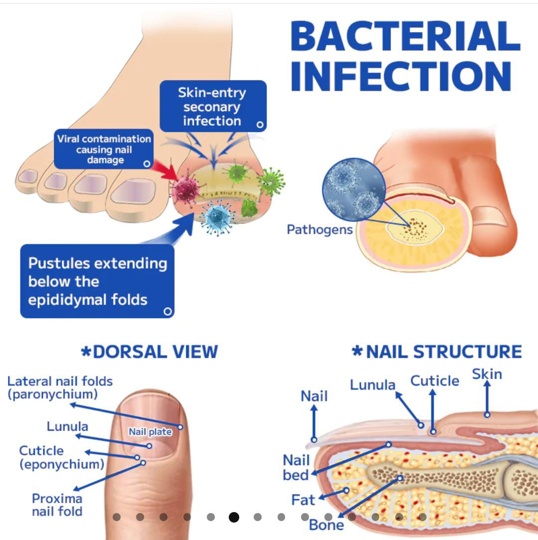 Fungal nail treatment laser device