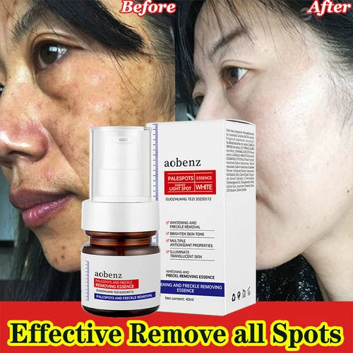 Vitamin C Whitening Freckles Face Cream Remove Melasma Dark Spots Lighten Melanin