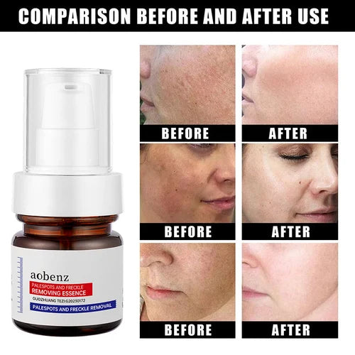 Vitamin C Whitening Freckles Face Cream Remove Melasma Dark Spots Lighten Melanin