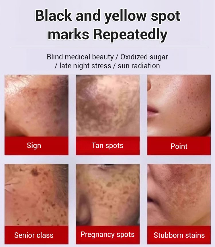 Upgraded anti-freckle essence oil