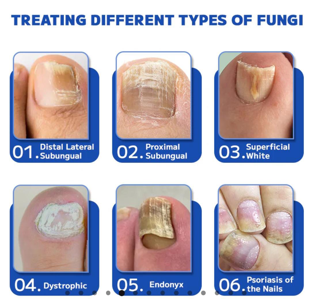 Fungal nail treatment laser device