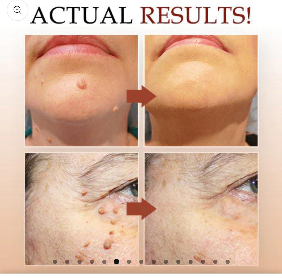 TAGS & MOLES REMOVER