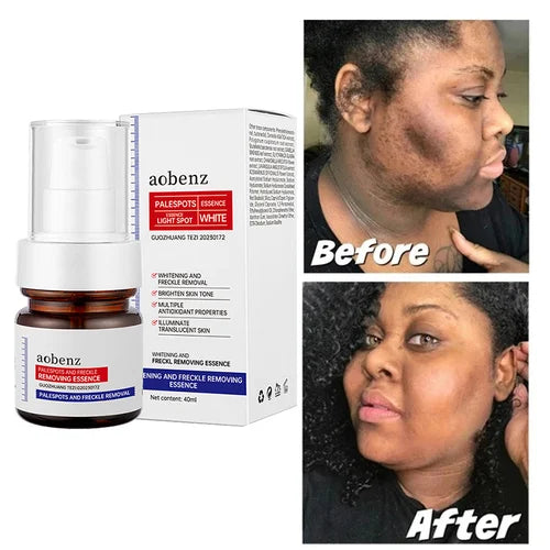 Vitamin C Whitening Freckles Face Cream Remove Melasma Dark Spots Lighten Melanin