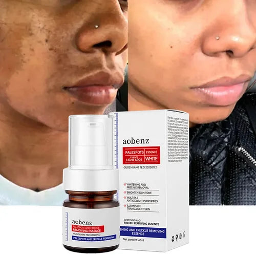 Vitamin C Whitening Freckles Face Cream Remove Melasma Dark Spots Lighten Melanin